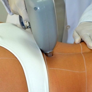 diode-laser-treatment
